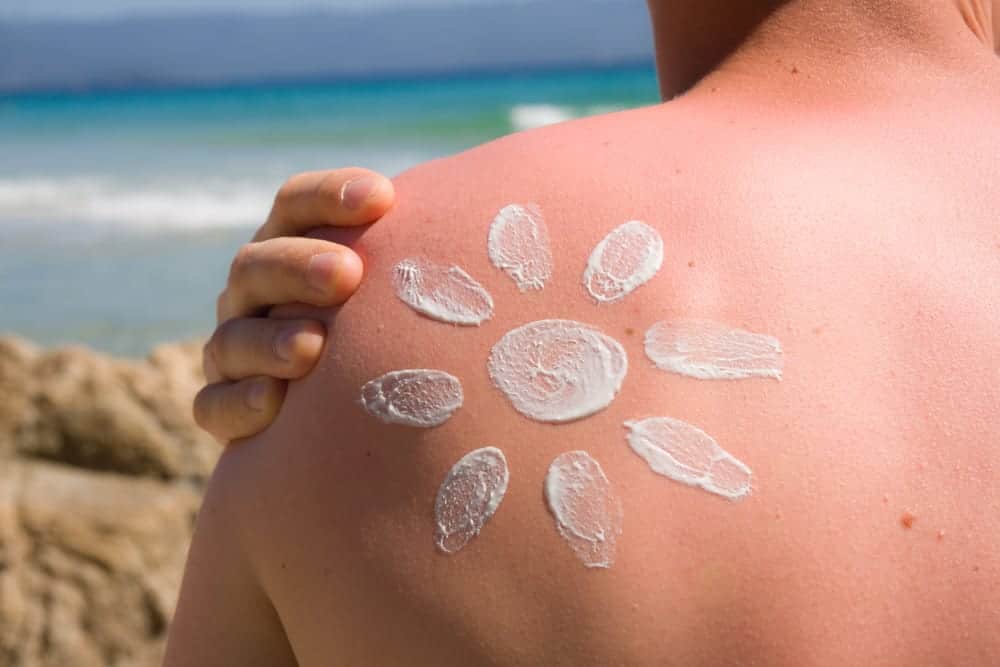 sunscreen on sunburnt shoulder